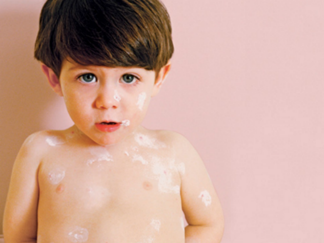 نقص صبغة الجلد عند الأطفال