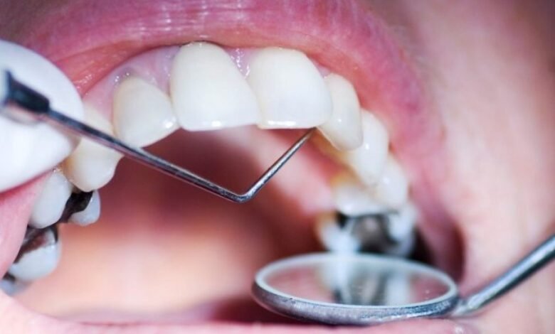 ما هي العادات الغذائية المسببة لتسوس الأسنان؟