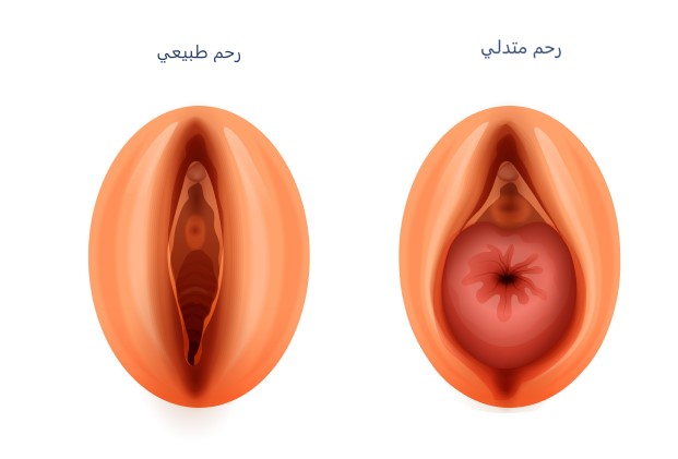 ما العلاقة بين هبوط الرحم والجماع؟