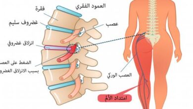 أعراض لعرق النسا في الرجلين