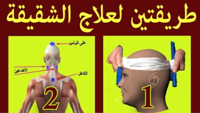 علاج الشقيقة بالحجامة