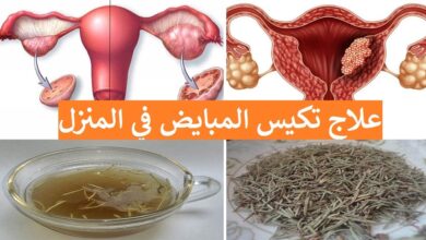 علاج تكيس المبايض بالأعشاب