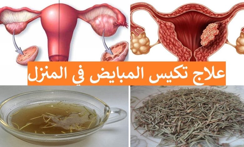 علاج تكيس المبايض بالأعشاب