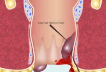 البواسير بعد الولادة