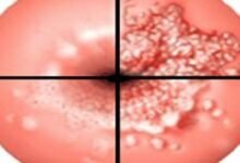 التهاب عنق الرحم