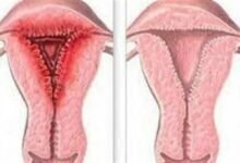 علاج الفطريات المهبلية المزمنة