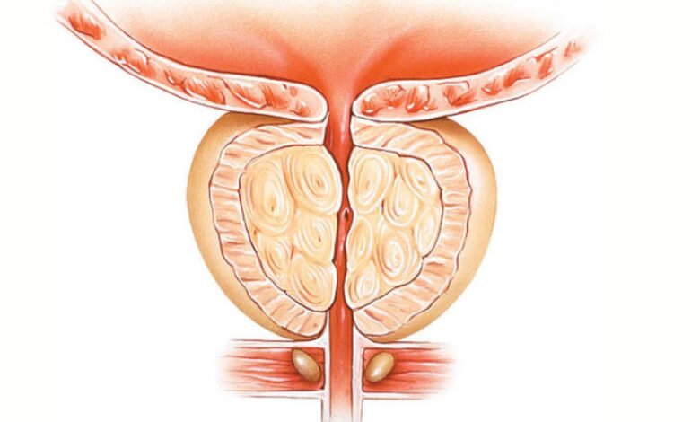 مشكلات البروستاتا