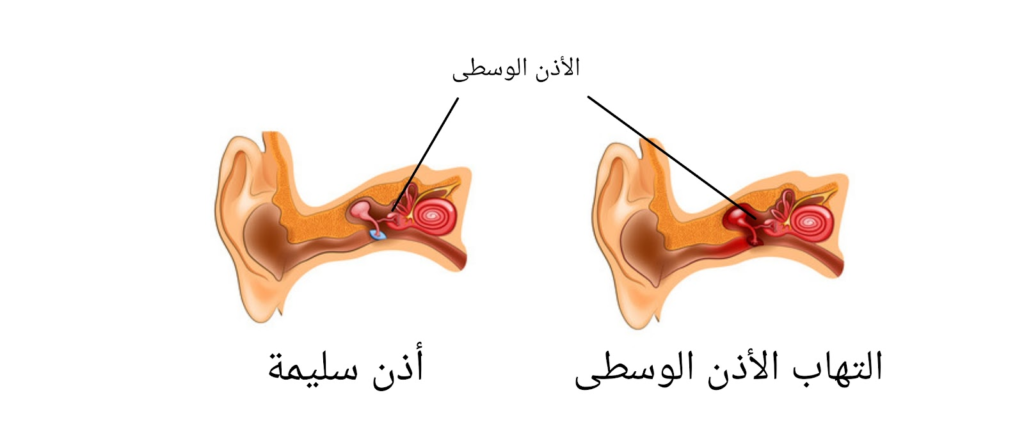 سبب التهاب الأذن الوسطى والدوخة