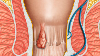أعراض البواسير الداخلية