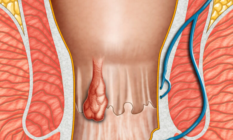أعراض البواسير الداخلية