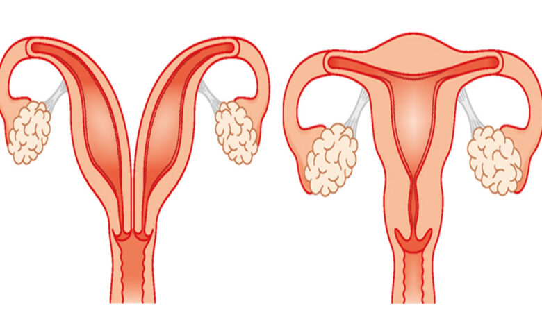 أسباب تشوهات الرحم