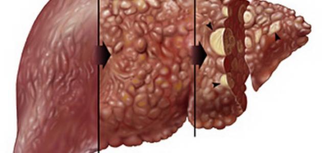 أعراض تليف الكبد وعلاجه