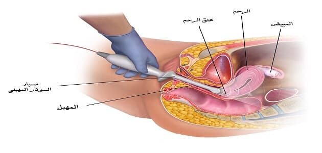 إجراء السونار المهبلي والسونار الخارجي