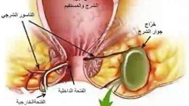 الناسور العصعصي والخراج والبواسير