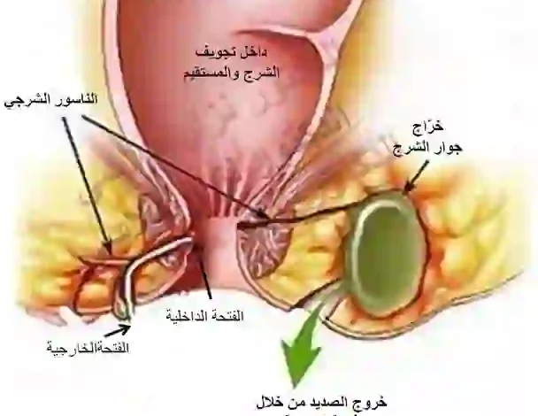 الناسور العصعصي والخراج والبواسير