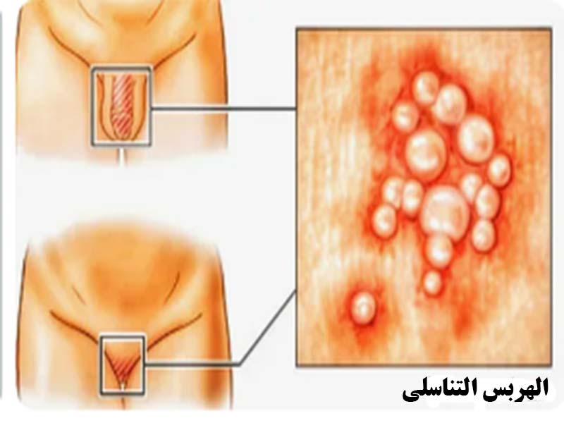 مرض الهربس التناسلي