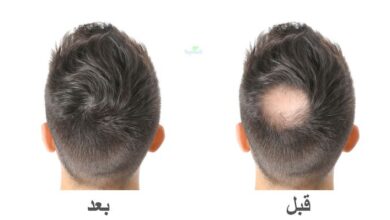 زراعة الشعر في الجزائر