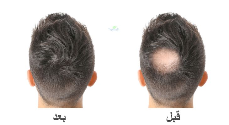 زراعة الشعر في الجزائر