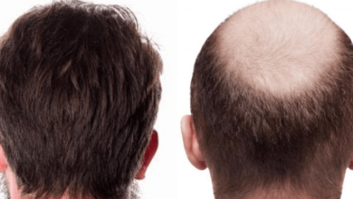 زراعة الشعر في الأردن