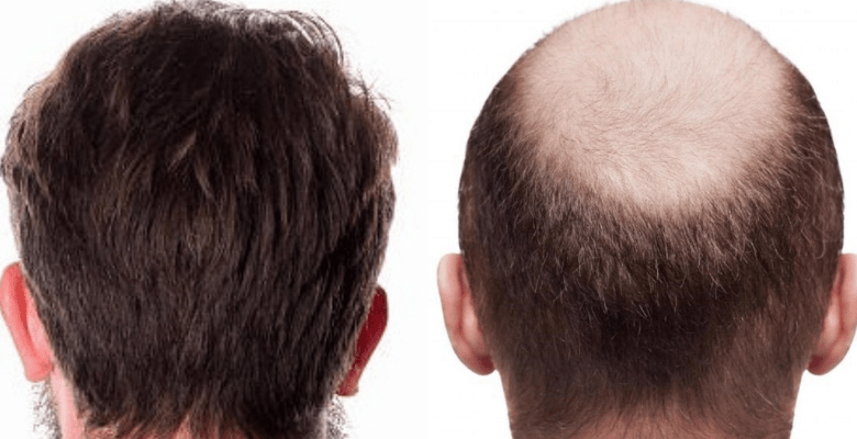 زراعة الشعر في الأردن