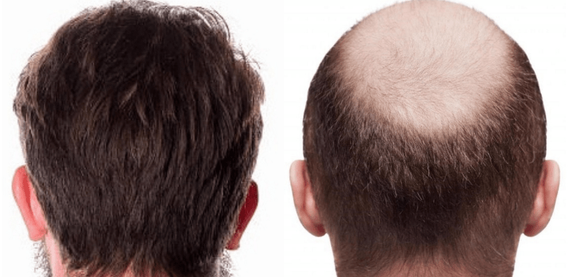 زراعة الشعر في الأردن