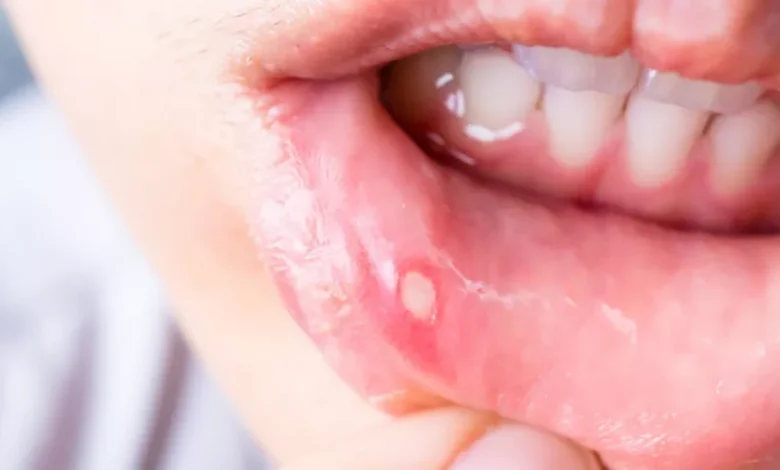 علاج تقرحات الفم واللثة