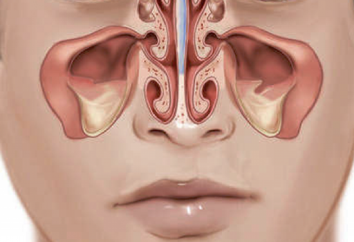 كل ما تودين معرفته عن عملية كي الجيوب الأنفية