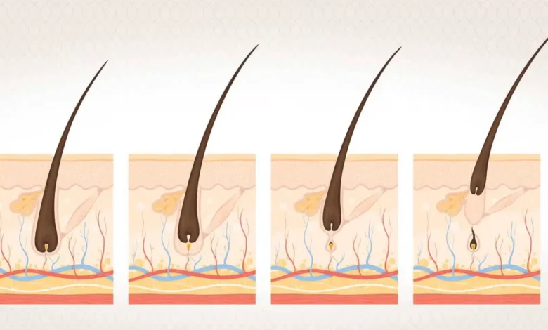 كيف تموت بصيلات الشعر