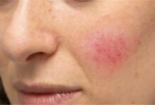 علامات في الوجه تنبئك بسرطان الرئة