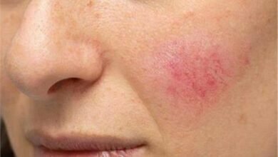 علامات في الوجه تنبئك بسرطان الرئة