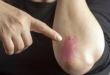 كيف تتعرف على الصدفية: 6 علامات مهمة