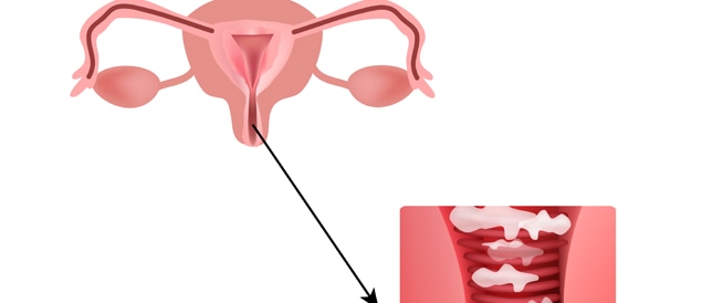 أعراض التهابات المهبل للمتزوجات