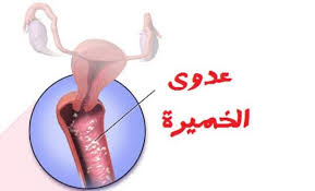 أسباب عدوى الخميرة المهبلية